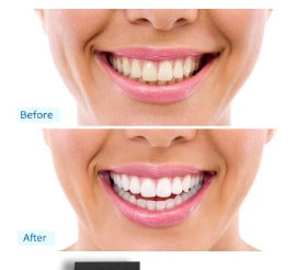 BrilloExpress – Mini Luz Blanqueadora Dental